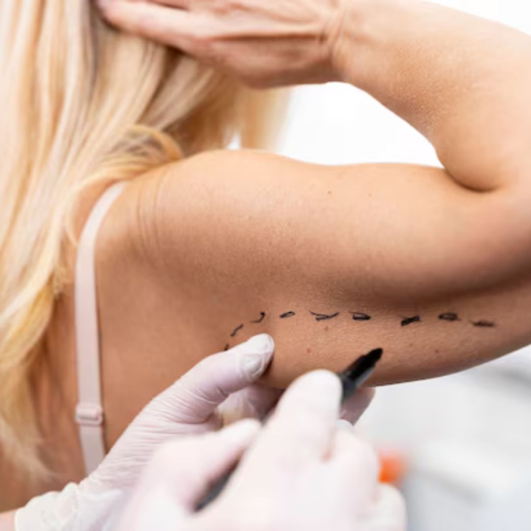 Stretchmark Treatment Surrey